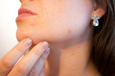 acne-voorkomen-of-genezen
