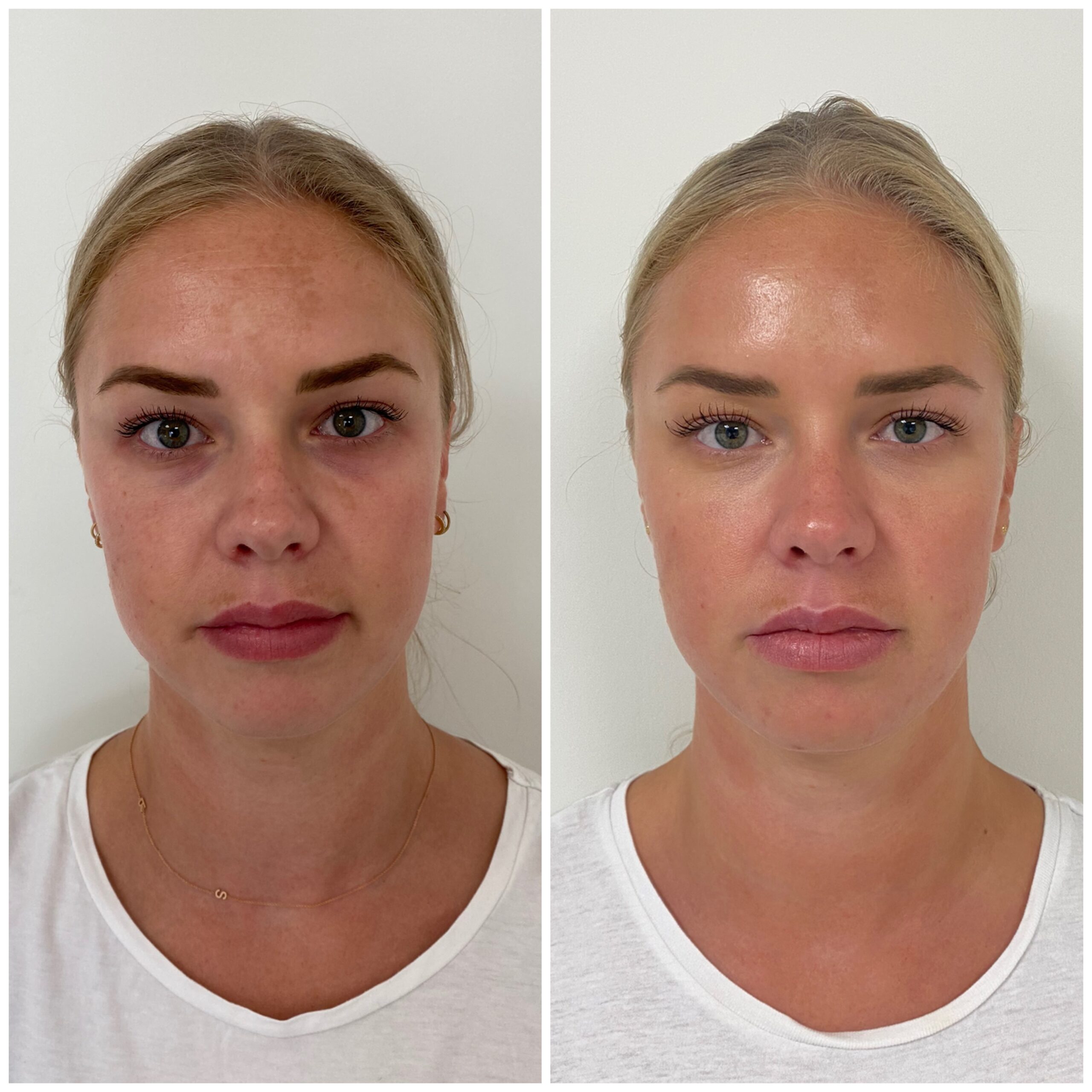 Voor en na Botox