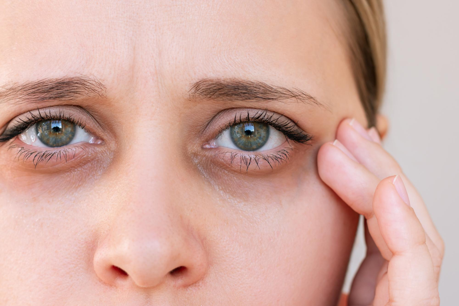 Close-up van een vrouw met zichtbare donkere kringen rondom haar ogen