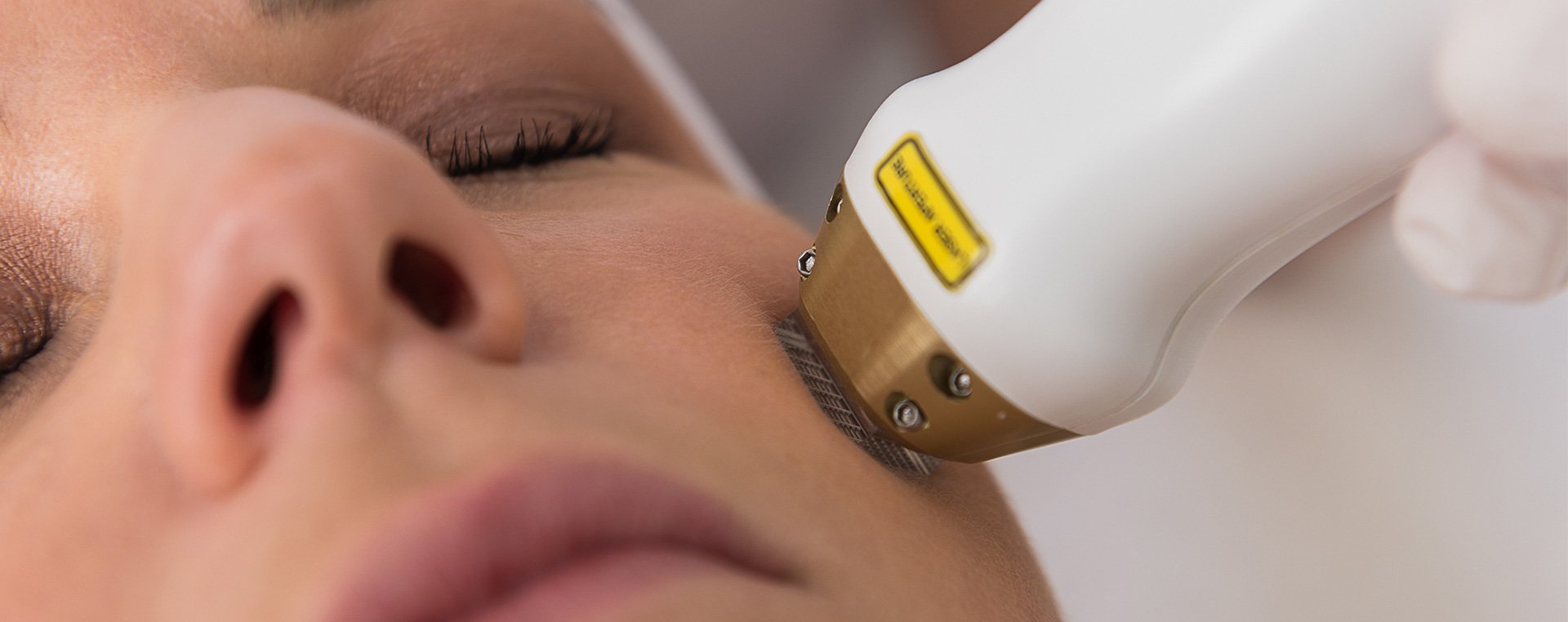 Acne laser behandeling